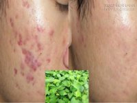 5 công thức trị thâm mụn, dưỡng da trắng mịn màng từ rau diếp cá
