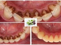 Giật mình với loại rau chưa đến 2k đánh sạch mảng bám, ố vàng trong 1 nốt nhạc