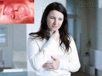 Trị đau họng dứt điểm bằng cách tự nhiên nhất
