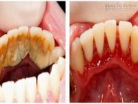 Cách lấy cao răng tại nhà hiệu quả và an toàn nhất