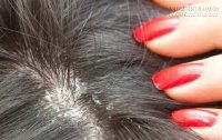 Công thức trị gàu phát huy tác dụng trong lần đầu tiên