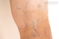 Có dấu hiệu này, bạn có thể đã mắc căn bệnh giãn tĩnh mạch