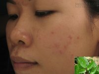 Xóa tan vết thâm mụn ngay tại nhà với các loại lá cây