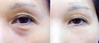Tôi trị quầng thâm mắt cực nhanh chỉ với 20 nghìn đồng