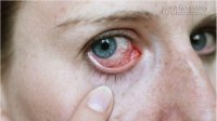 Mẹo chữa trị đau mắt đỏ tự nhiên