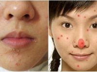 Đoán bệnh nguy hiểm qua vị trí mụn
