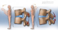 Các bài tập cho thoát vị đĩa đệm cột sống thắt lưng