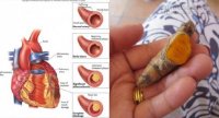 Công thức siêu cường từ nghệ giúp bảo vệ tim mạch, hết đột quỵ