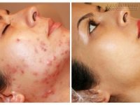 Trị mụn ở mặt và toàn thân siêu tốc chỉ với 1 nắm thứ này