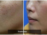 3 cách trị nám vĩnh viễn chưa đến 5k ngay tại nhà không một Spa nào sánh bằng