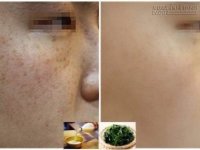 Phát sốt với 5 công thức trị nám nổi tiếng hiệu quả trong 1 tháng của người Hàn
