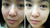 Bài thuốc chữa tàn nhang, vết nám lâu năm khỏi ngay tức khắc