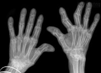 Xét nghiệm dự đoán bệnh viêm khớp dạng thấp trước 16 năm