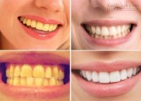 Răng trắng sáng, hết mảng bám sau 1 tuần nhờ hỗn hợp rẻ như cho
