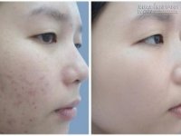 Không cần mỹ phẩm đắt tiền, không cần dùng thuốc, sẹo thâm tự mờ đi khi thoa thứ này