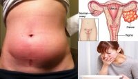 10 triệu chứng của kẻ giết người thầm lặng, có khi chị em bị rồi mà không biết!