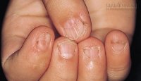 8 biểu hiện cảnh báo cơ thể thiếu sắt có nguy hại tới sức khỏe