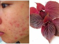 Loại bỏ mụn tức khắc nhờ mặt nạ từ lá cây