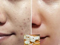Trị sẹo thâm lâu năm hiệu quả 100% nhờ hành tây