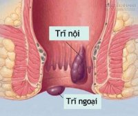 Kinh nghiệm chữa khỏi bệnh trĩ trong 2 tháng