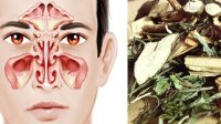 Hàng nghìn người bị viêm xoang, viêm mũi được giải cứu nhờ bài thuốc này
