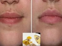 Tự chế mặt nạ giúp chị em tẩy ria mép hiệu quả