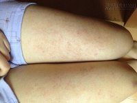 Trị dứt điểm viêm lỗ chân lông bằng cách đơn giản