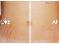 Công thức xóa vết rạn da đơn giản tại nhà mà hiệu quả không kém gì spa