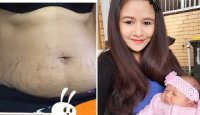 Công thức trị rạn da sau sinh đơn giản mà hiệu quả bất ngờ của một mẹ Việt