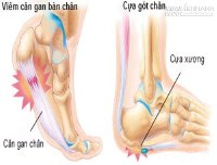 Mẹo hay trị hết đau gót chân, gai xương gót không dùng thuốc