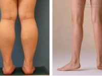 3 động tác siêu đơn giản giúp bạn sở hữu đôi chân thon chỉ sau 1 tháng