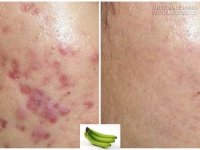 Đánh bay sẹo thâm giúp da trắng sáng không tì vết chỉ từ 1 quả chuối xanh