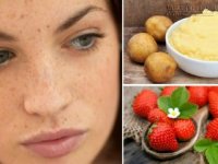 Công thức trị tàn nhang không hề tốn tiền