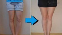 Ai đang bị chân vòng kiềng nhất định phải đọc bài viết này