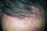 Khốn khổ với căn bệnh đau đớn hơn ung thư giai đoạn cuối, sống không bằng chết