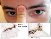 20 giây trị dứt nghẹt mũi do viêm xoang và hướng dẫn tống cổ viêm xoang ngay lập tức