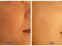 4 bí quyết trị sẹo lõm bằng phương pháp thiên nhiên hiệu quả đến 95%