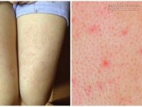 Hết viêm nang lông, viêm lỗ chân lông trong 1 tháng chỉ bằng cách tắm với nước muối