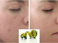 Chỉ cần 15 phút mỗi tuần, da sẽ hết 95% mụn nhờ vỏ chanh