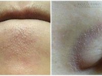 Hỗn hợp loại sạch mụn cám, mụn li ti ở cằm và cánh mũi chỉ sau 7 phút