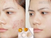 Không cần nặn, đảm bảo mụn vẫn hết sạch và không có vết thâm với nguyên liệu rẻ bèo