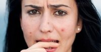 7 cách loại bỏ mụn bọc siêu tốc chỉ trong 1 đêm không đau, không sưng tấy