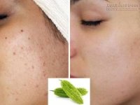 Tuyệt chiêu để mụn ẩn tự khắc chui ra chỉ bằng mướp đắng