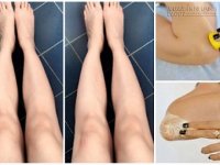 Độc chiêu trị thâm khuỷu tay và đầu gối hiệu quả