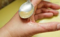 Dù bị bỏng nặng đến đâu, thực hiện sơ cứu theo cách này sẽ khỏi