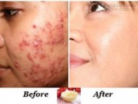 Chỉ cần chà hỗn hợp này lên da sẽ trắng sáng, sạch mụn, hết vết thâm