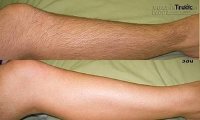 Tuyệt chiêu triệt sạch lông chân tay vĩnh viễn chỉ bằng…vôi sống