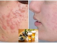 Bất ngờ với khả năng tiêu diệt mụn chỉ trong vài ngày của bia, thuốc nhỏ mắt, thuốc mỡ mắt