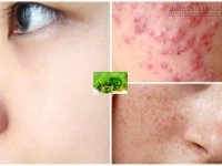 Biết độc chiêu này da bạn sẽ sạch mụn, hết tàn nhang trong vòng 1 nốt nhạc