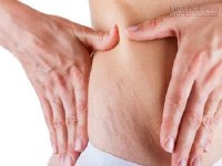 Mẹo chữa rạn da chắc chắn thành công